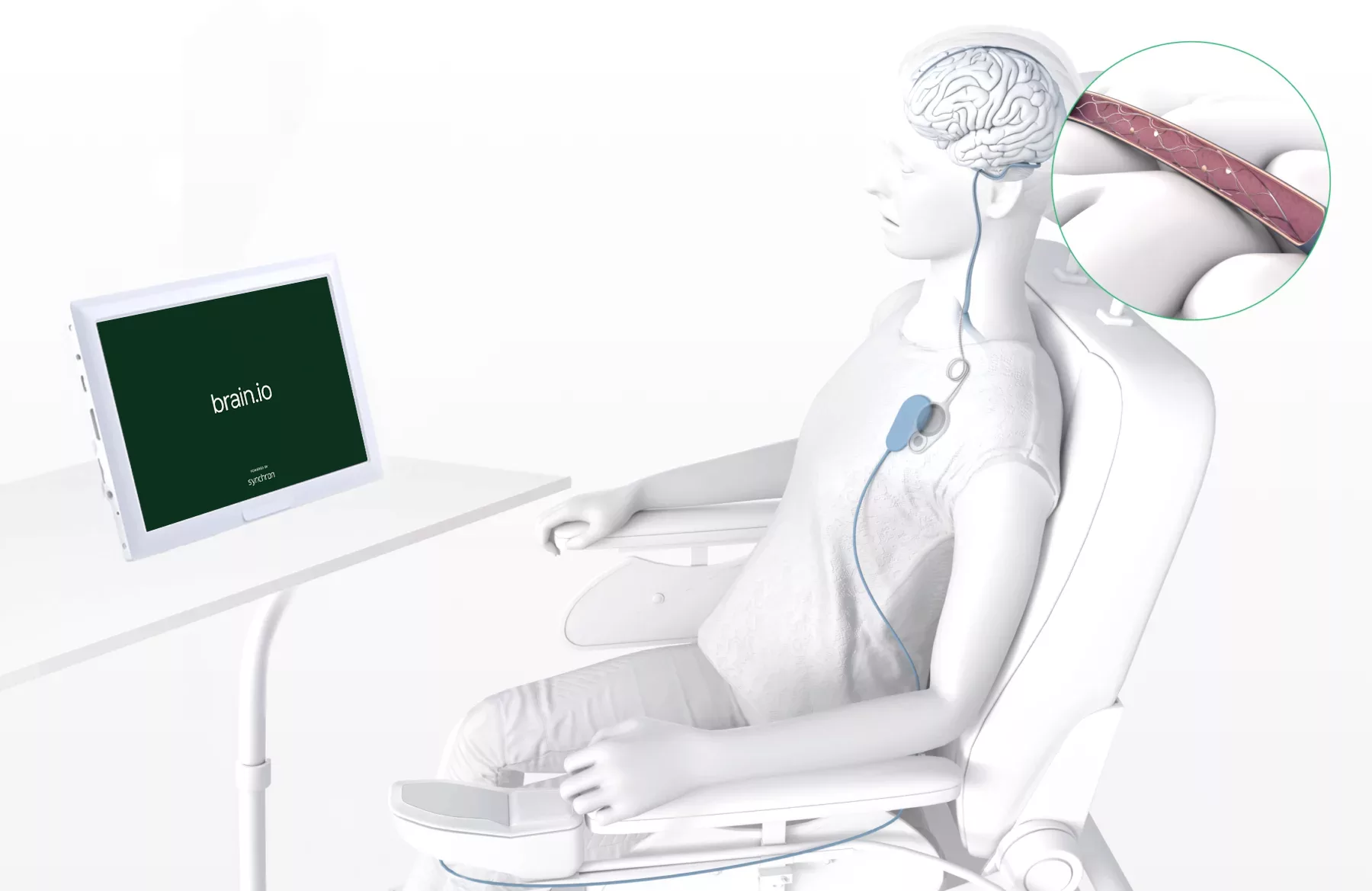 A representation of a person shown with a wire leading from a device in a vein in their brain to a device implanted in their chest. Another device is worn overlapping the implant, with a wire leading down and to a computer in front of the person.